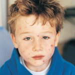 Molluscum contagiosum при деца