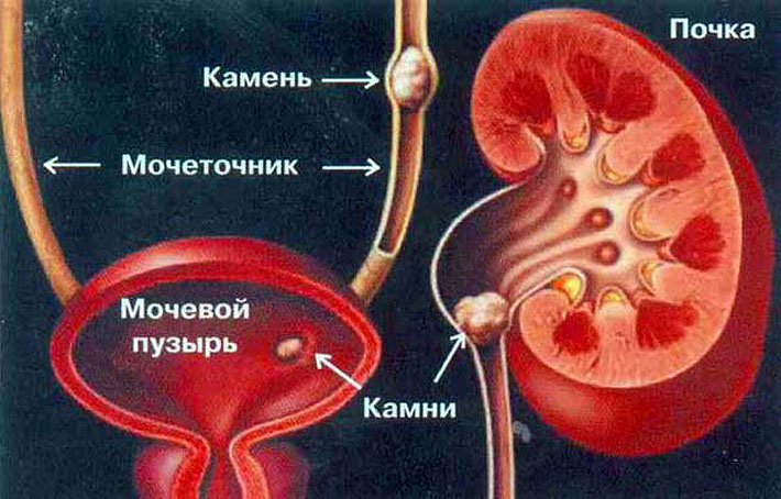 Бъбречни камъни: лечение с народни средства