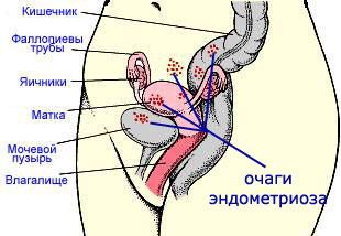 Ендометриоза: лечение с народни средства
