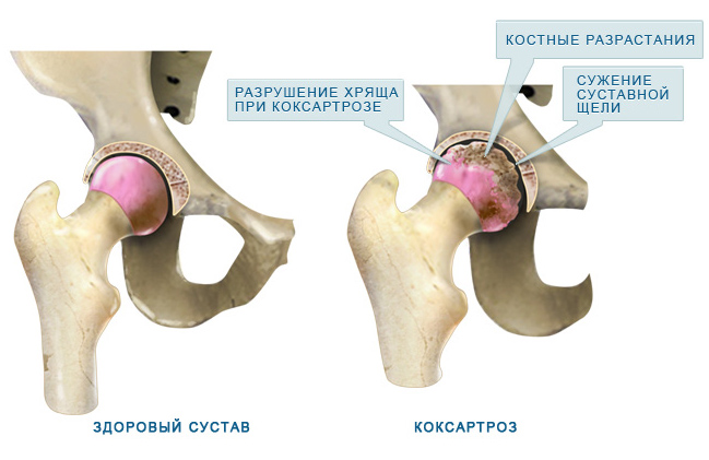 Лечение на заболявания на тазобедрените лечебни средства