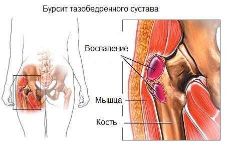 Лечение на заболявания на тазобедрените лечебни средства