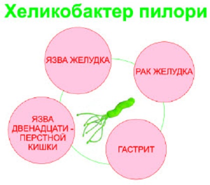 Лечение на стомашни язви с народни средства
