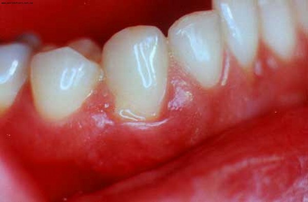 Какво възбужда - венците или зъбите? Защо се надраска венците при възрастни? Как да се отървем от дискомфорт?
