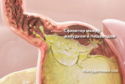 Какво да направите, ако имате киселини в стомаха