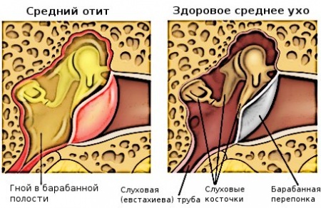 Как да се лекува уртикали в дома?