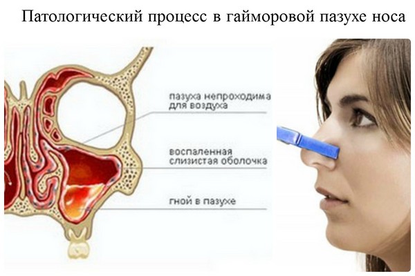 Кафява глава: защо е важно да започнете лечението навреме