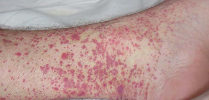 Vasculitis - какво е това? Симптоми, снимки, лечение